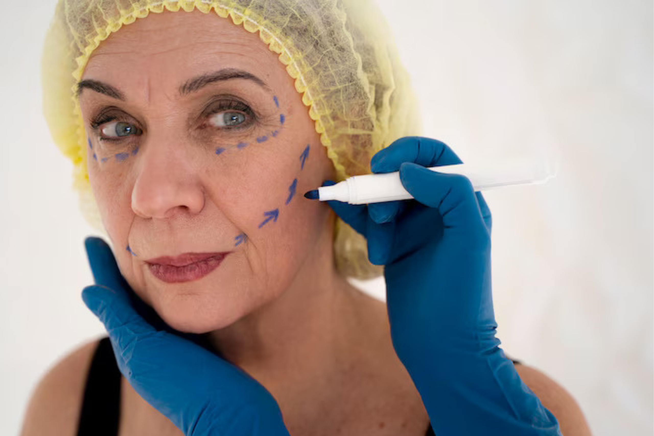 Fillers  Fillers verminderen fijne lijntjes, rimpels en geven volume voor een frissere, jeugdige uitstraling.  Boek Nu